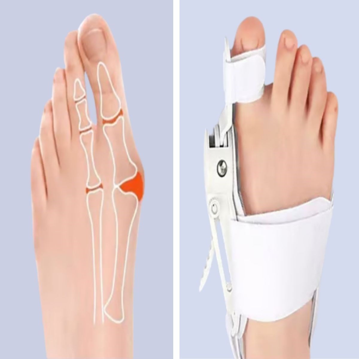 Ayarlanabilir Ayak Baş Parmak Kemik Düzeltici – Halluks Valgus (Bunyon) Aparatı, Gece Gündüz Kullanıma Uygun Ayak Düzeltme Ateli (5296) - Görsel 3